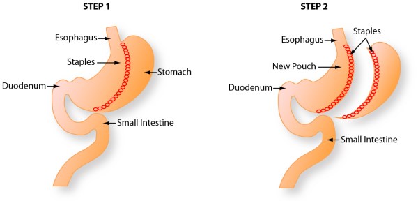 What Is Gastric Sleeve Surgery